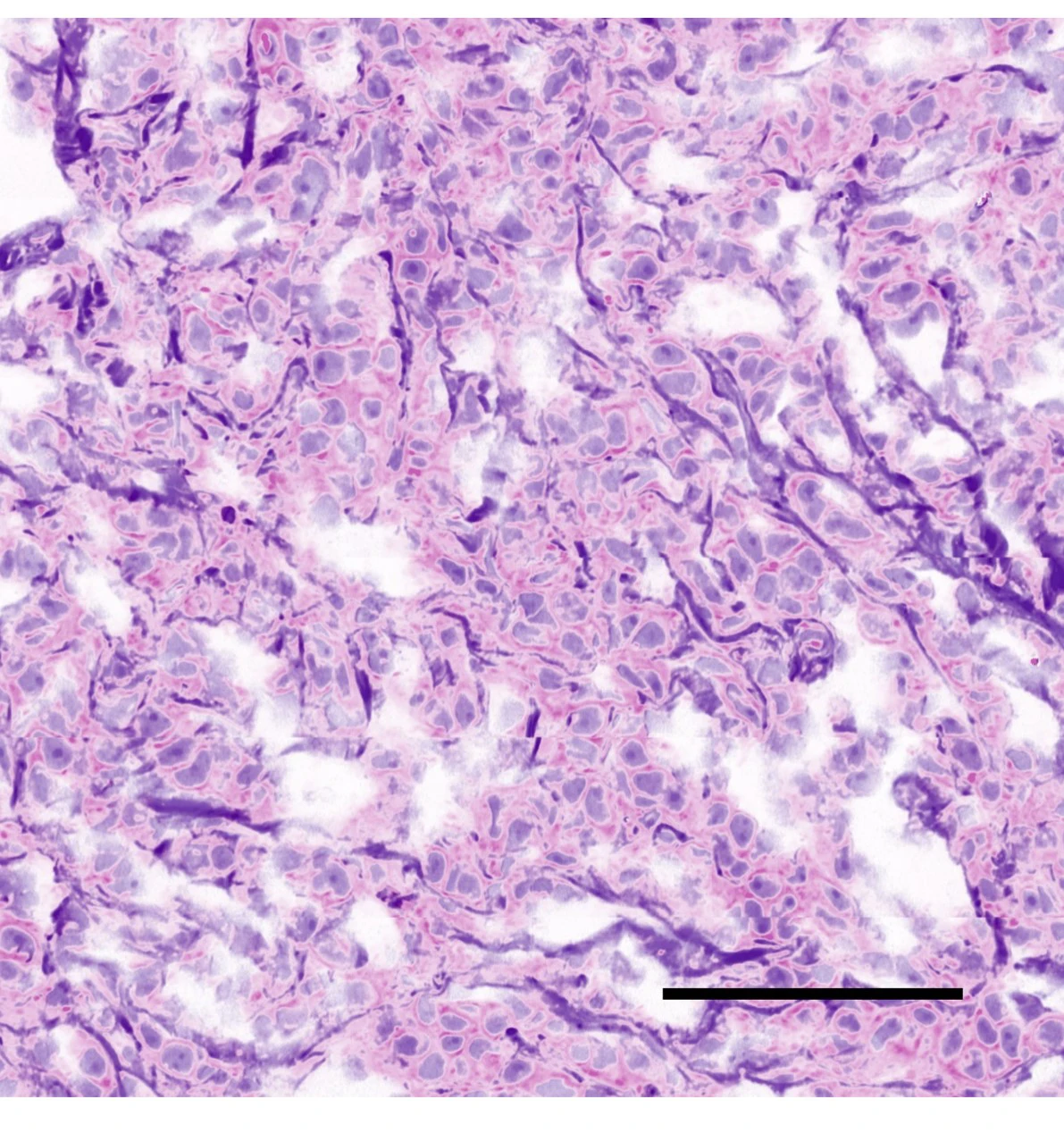 Virtual H&E image of cancerous breast tissue