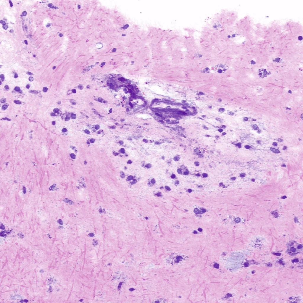 Virtual H&E image of a Glioblastoma tissue